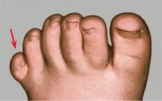 microdactyly pinky toe