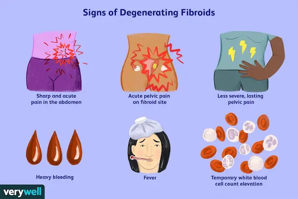 signs-of-fibroids-breaking-down-by-verywell