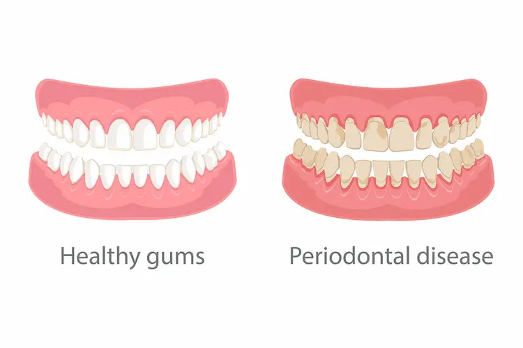 periodontist-fix-receding-gums